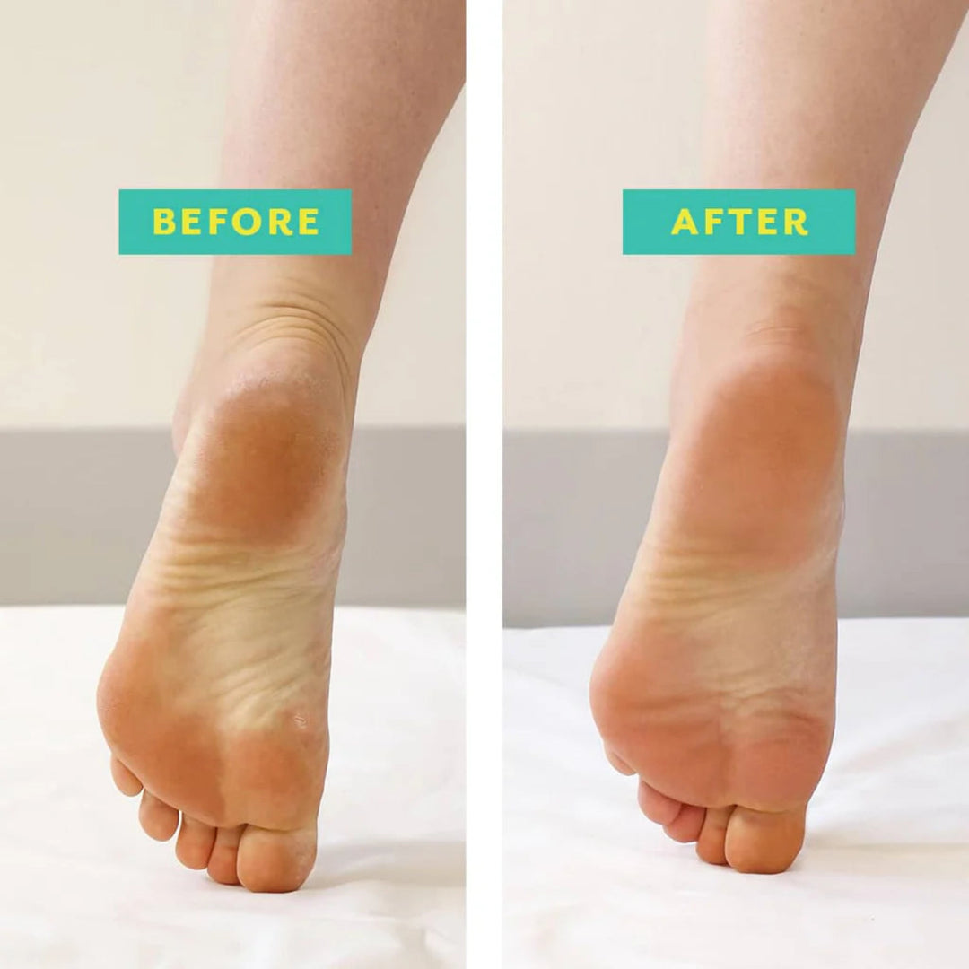 Poshpeel Exfoliating Foot Peel