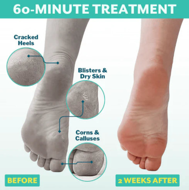 Poshpeel Exfoliating Foot Peel